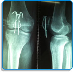 traumatologia y ortopedia rodilla