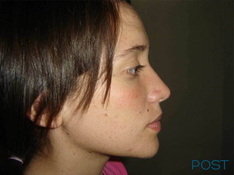 cirugia facial rinoplastia post
