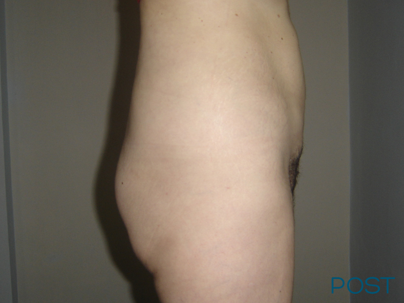 cirugia abdominoplastia 1 post