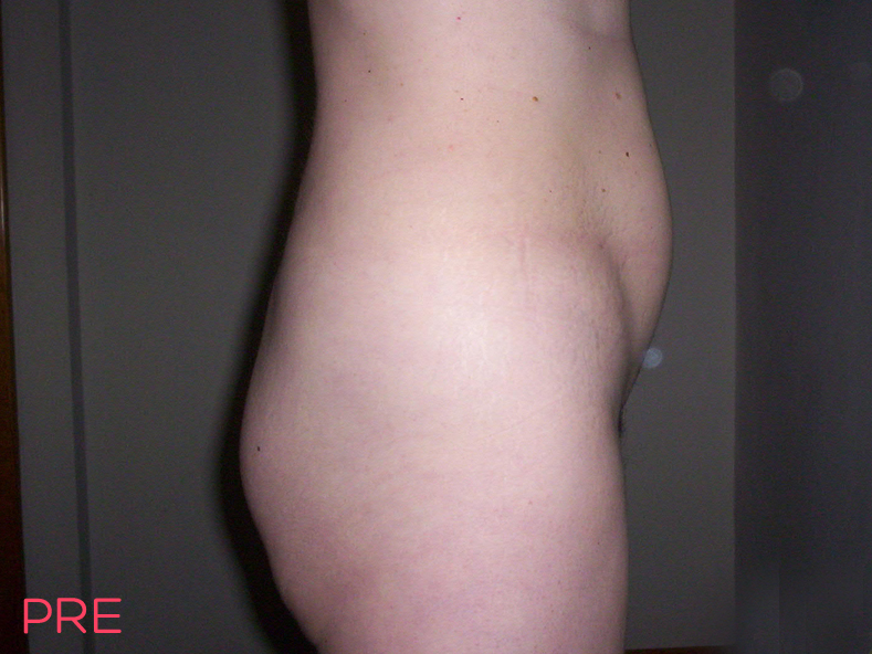 cirugia abdominoplastia 1 pre