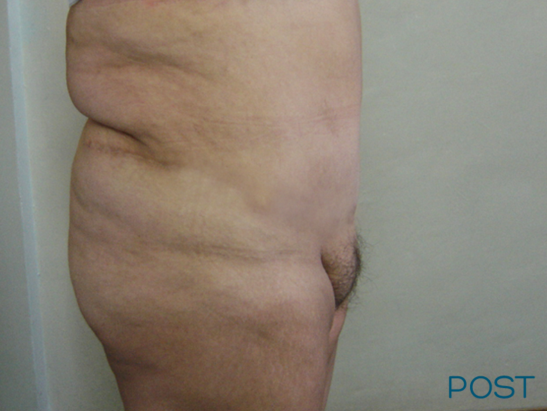 cirugia abdominoplastia 2 post