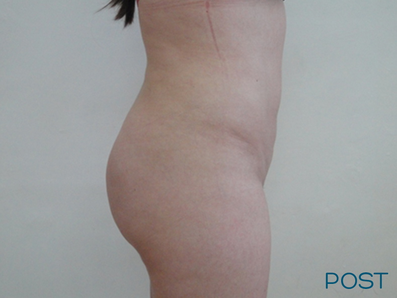 cirugia de contorno corporal lipoescultura y trasplante de grasa a gluteos post