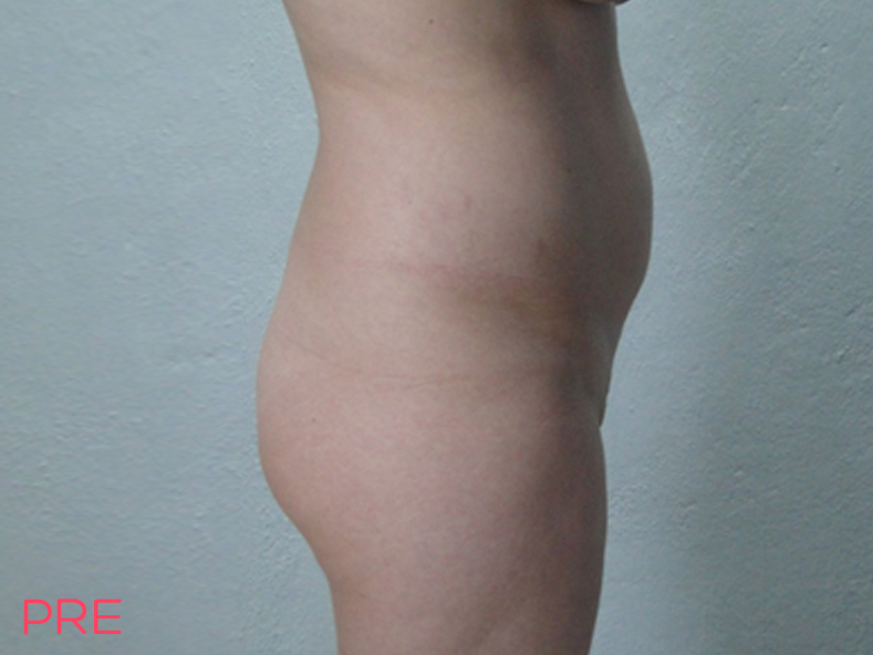 cirugia de contorno corporal lipoescultura y trasplante de grasa a gluteos pre