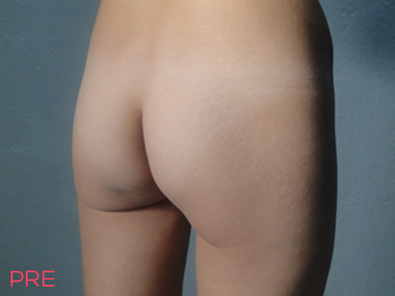 cirugia gluteos 1 pre