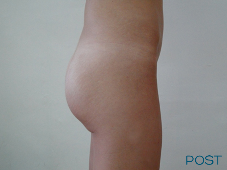 cirugia gluteos 2 post