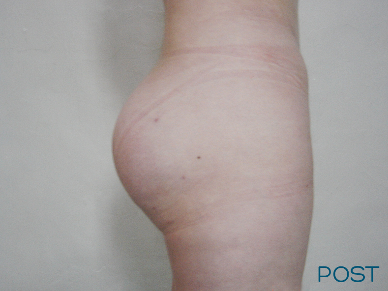 cirugia gluteos 3 post