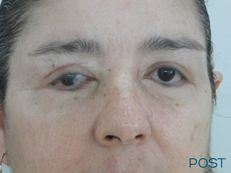 blefaroplastia post