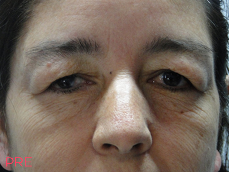 blefaroplastia pre