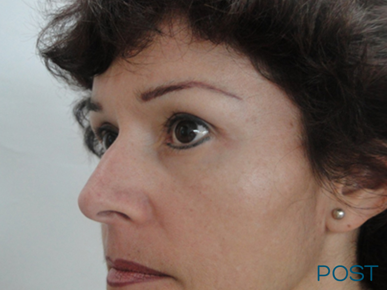 cirugia facial blefaroplastia 1 post