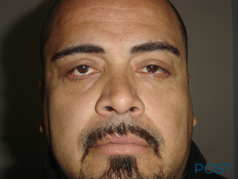 cirugia facial blefaroplastia 2 post