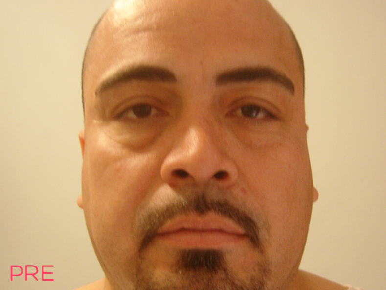 cirugia facial blefaroplastia 2 pre