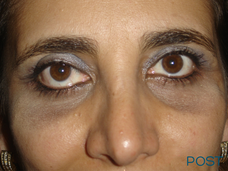 cirugia facial blefaroplastia 3 post