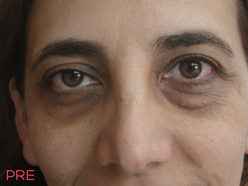 cirugia facial blefaroplastia 3 pre