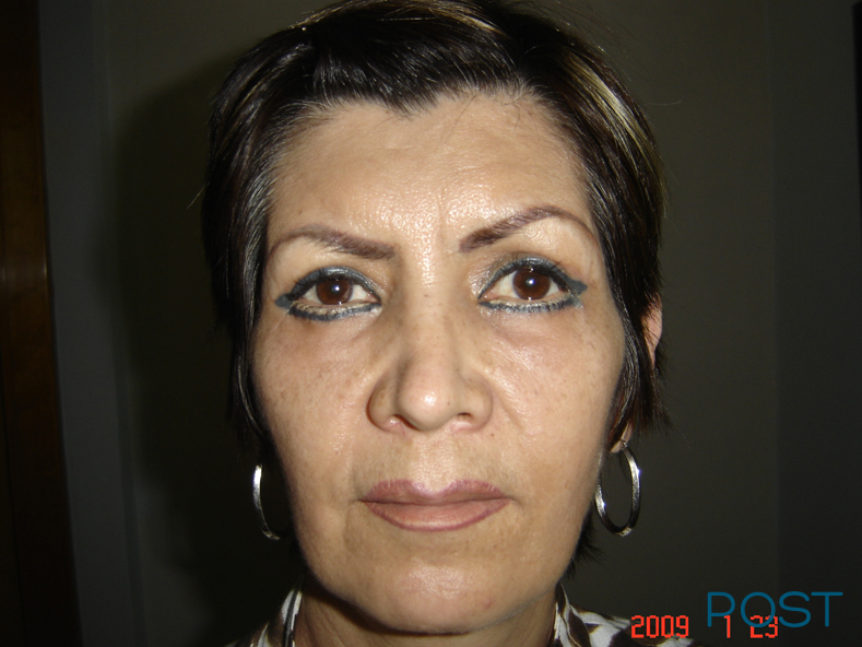 cirugia facial blefaroplastia post