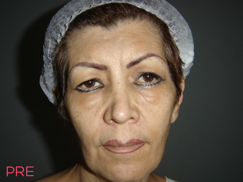 cirugia facial blefaroplastia pre