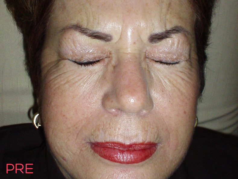 cirugia facial botox pre