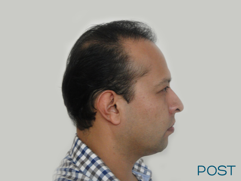 cirugia facial microtrasplante de cabello 1 post