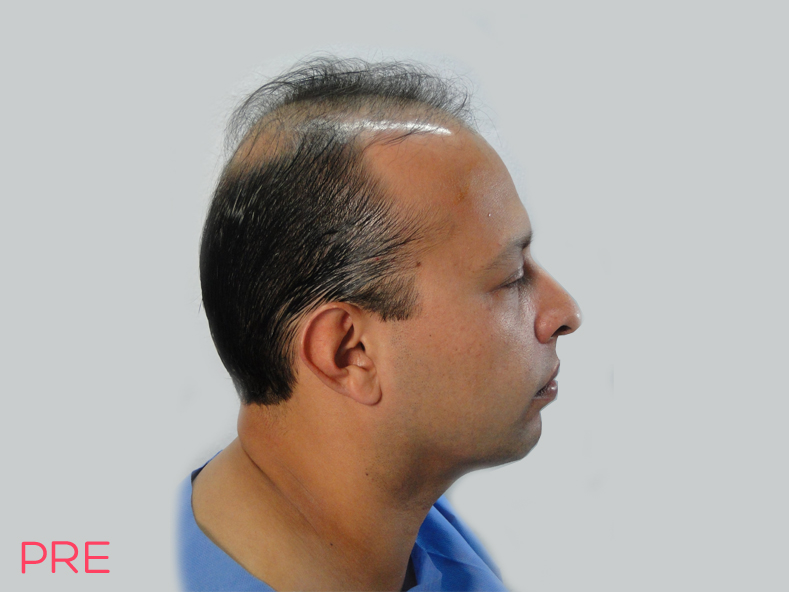 cirugia facial microtrasplante de cabello 1 pre