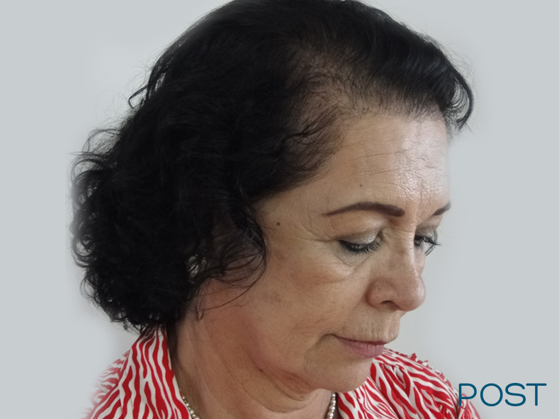 cirugia facial microtrasplante de cabello 3 post