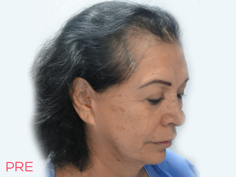 cirugia facial microtrasplante de cabello 3 pre