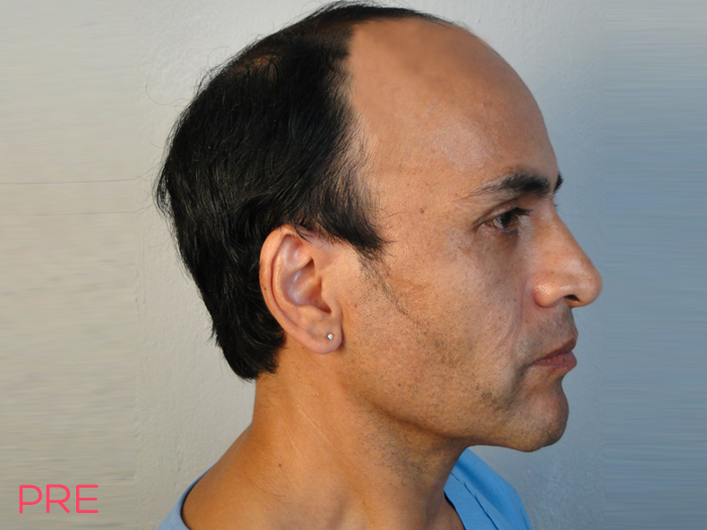 cirugia facial microtrasplante de cabello pre