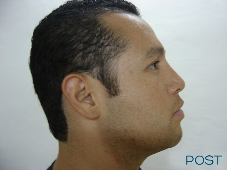 cirugia facial rinoplastia 2 post