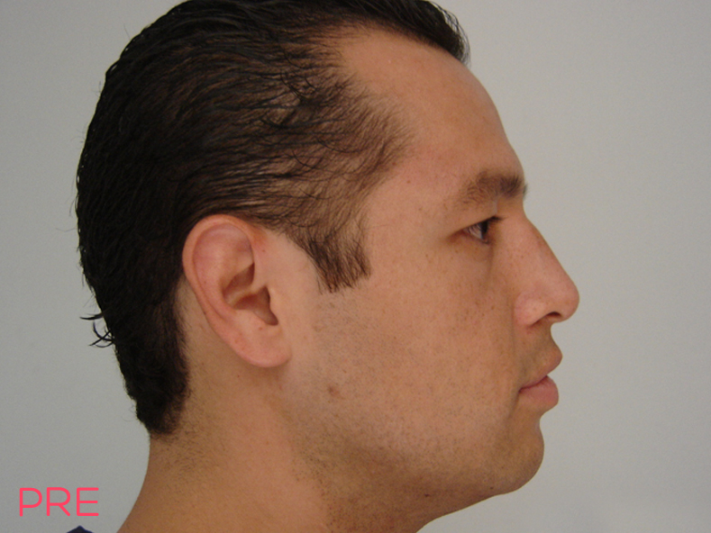 cirugia facial rinoplastia 2 pre