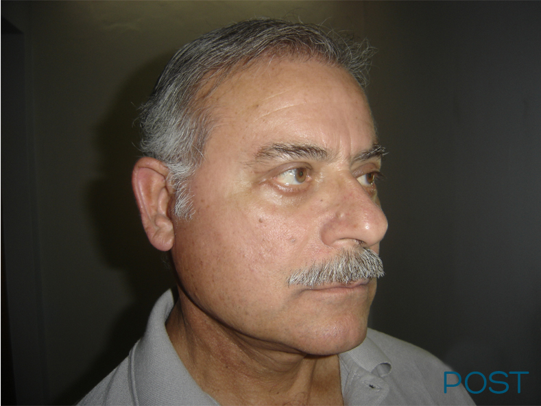 cirugia facial ritidectomia 2 post