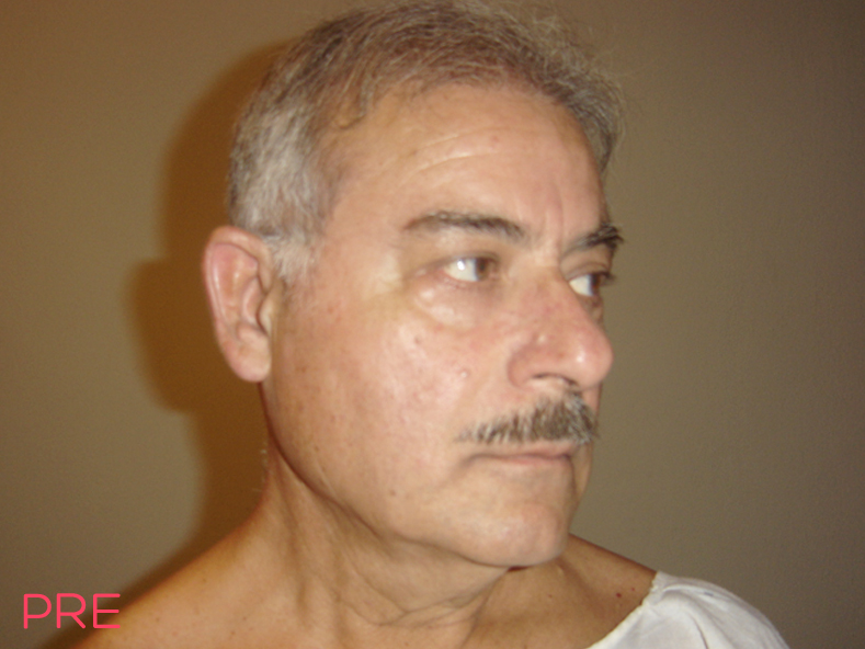 cirugia facial ritidectomia 2 pre