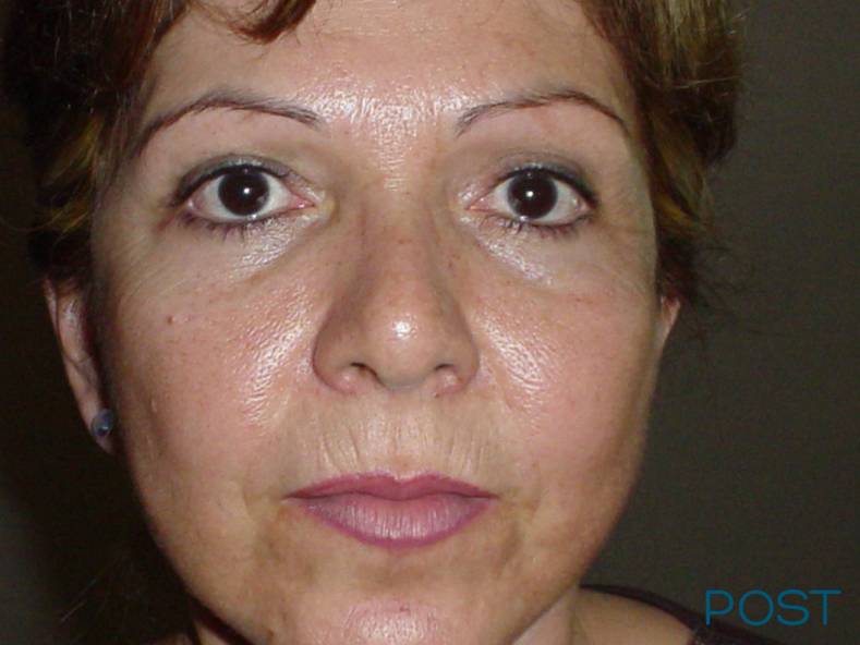 cirugia facial ritidectomia 3 post