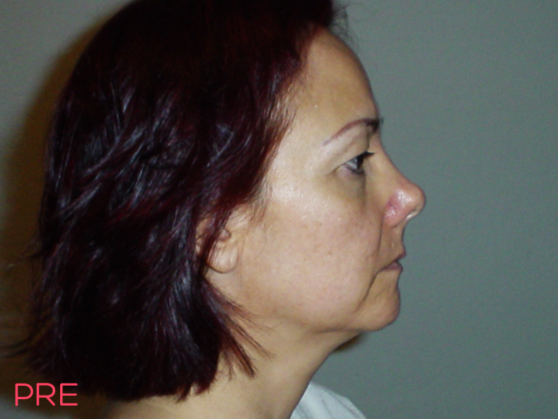 cirugia facial ritidectomia pre