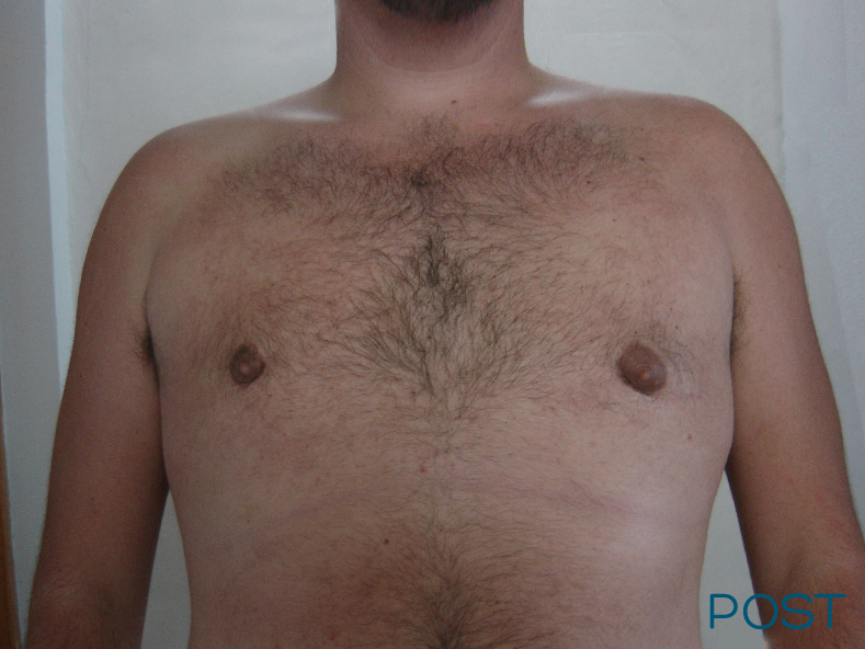 cirugia para hombres ginecomastia 2 post