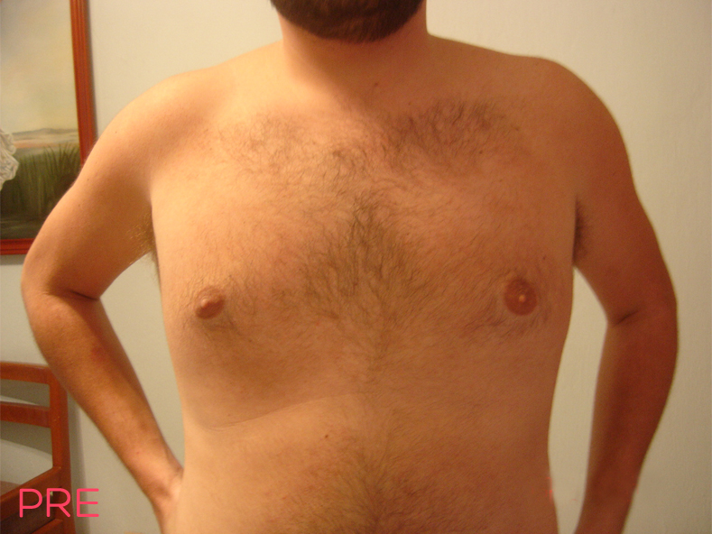 cirugia para hombres ginecomastia 2 pre