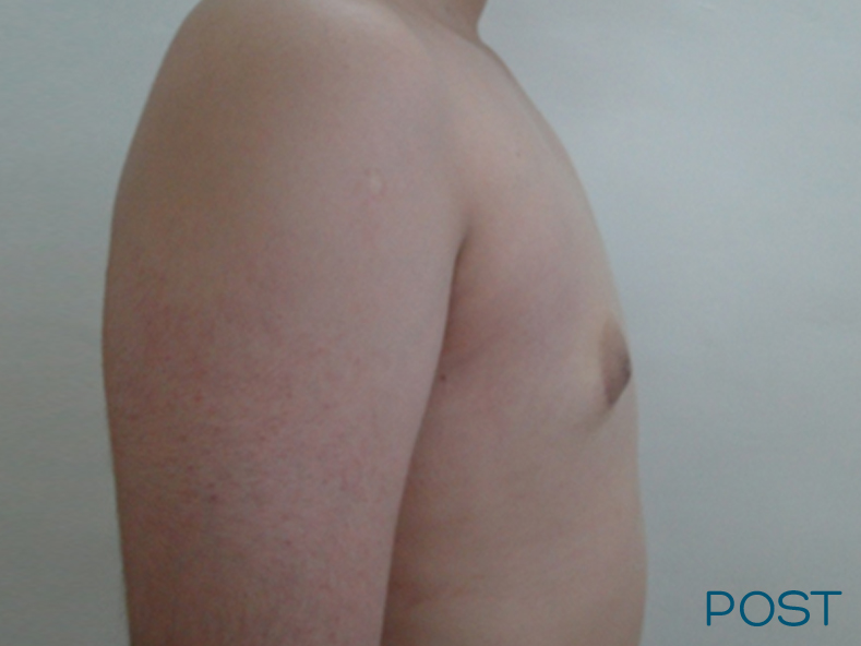 cirugia para hombres ginecomastia 3 post