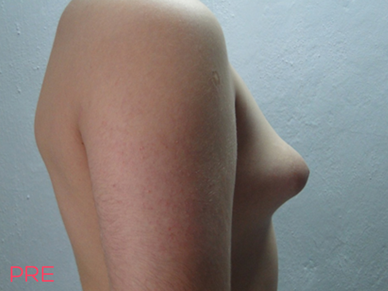 cirugia para hombres ginecomastia 3 pre