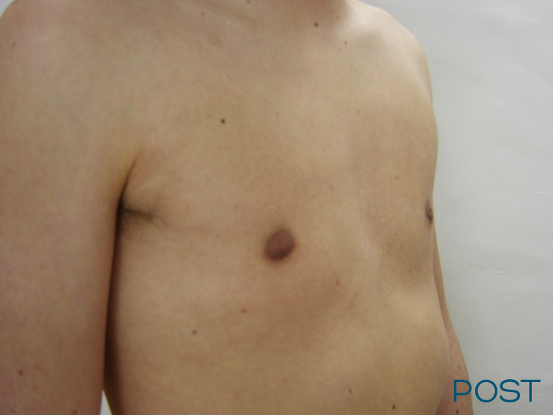 cirugia para hombres ginecomastia post