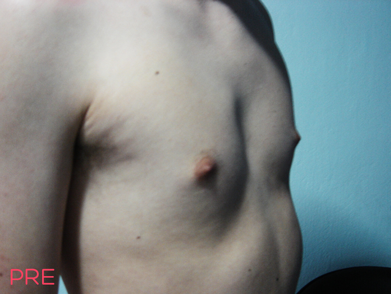 cirugia para hombres ginecomastia pre