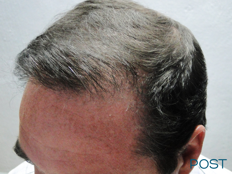 cirugia para hombres microtrasplante de cabello post