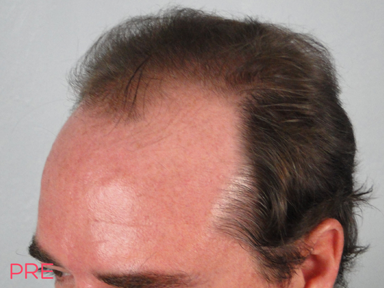 cirugia para hombres microtrasplante de cabello pre
