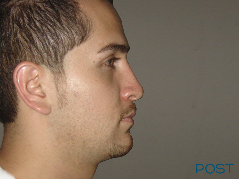 cirugia para hombres rinoplastia 2 post