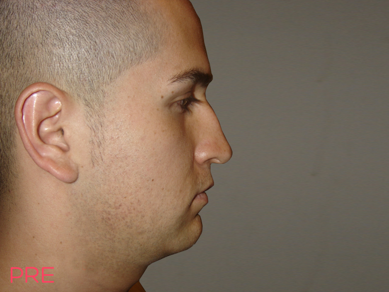 cirugia para hombres rinoplastia 2 pre