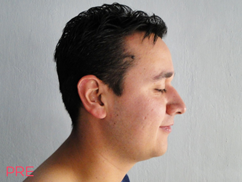 cirugia para hombres rinoplastia 3 pre
