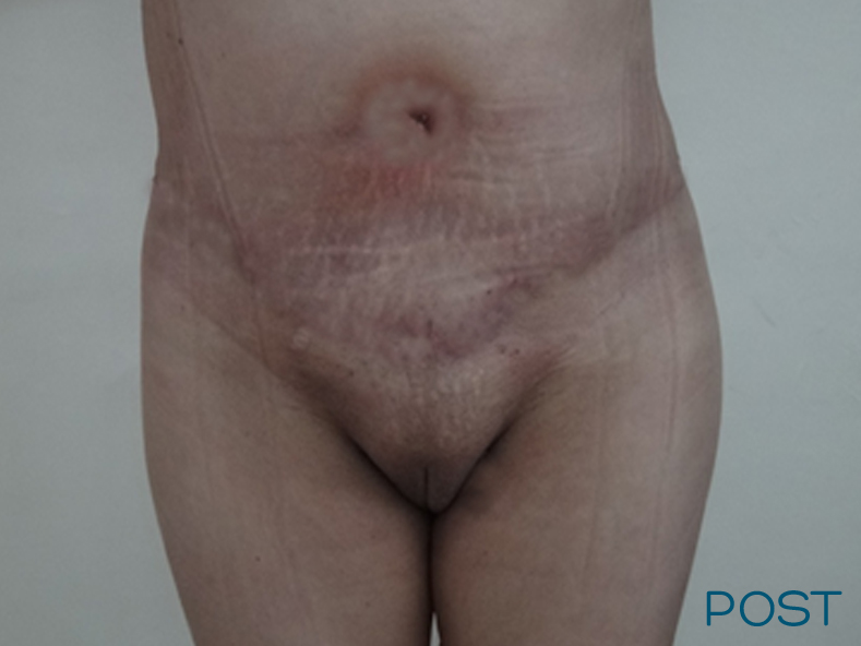 galeria abdominoplastia post 1