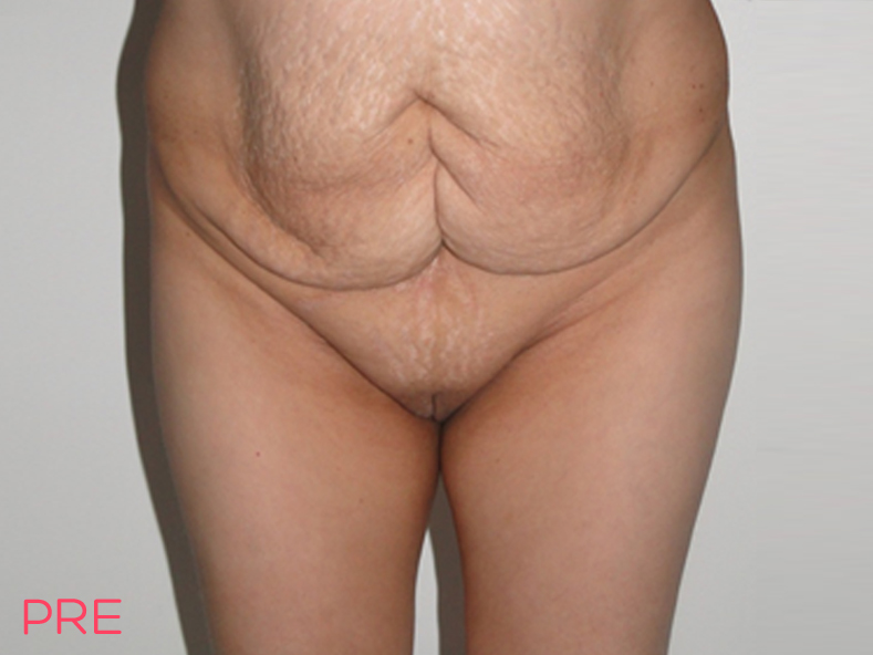 galeria abdominoplastia pre 1